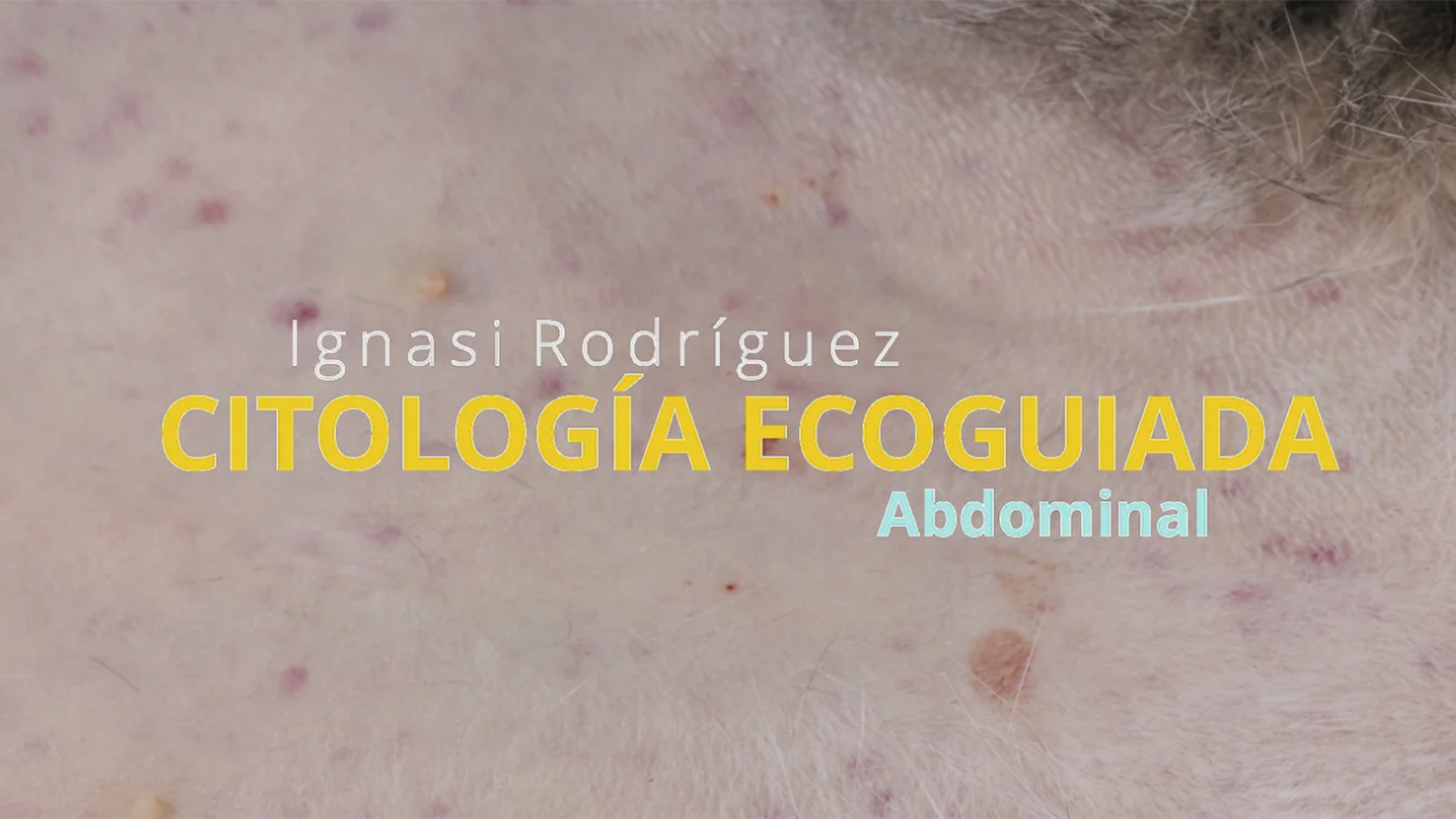 Citología abdominal ecoguiada