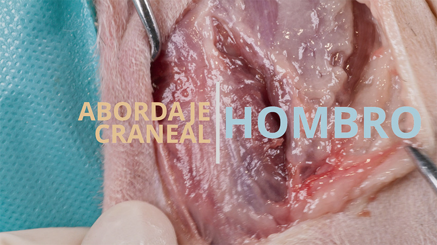 Abordaje craneolateral al hombro